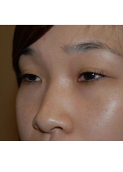 Before Image: Asian Double Eyelid - left-front-oblique