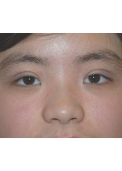 After Image: Asian Double Eyelid - front