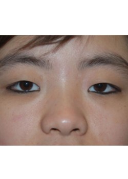 Before Image: Asian Double Eyelid - front