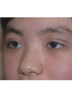 After Image: Asian Double Eyelid - left-front-oblique