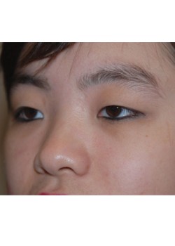 Before Image: Asian Double Eyelid - left-front-oblique