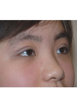 After Image: Asian Double Eyelid - right-front-oblique