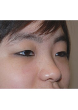 Before Image: Asian Double Eyelid - right-front-oblique
