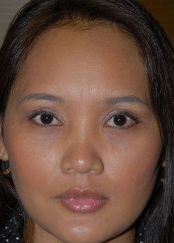 After Image: Asian Double Eyelid & Lower Eyelid - front