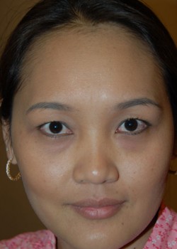 Before Image: Asian Double Eyelid & Lower Eyelid - front