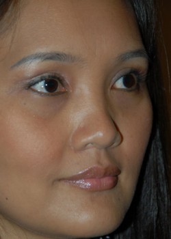 After Image: Asian Double Eyelid & Lower Eyelid - right-front-oblique