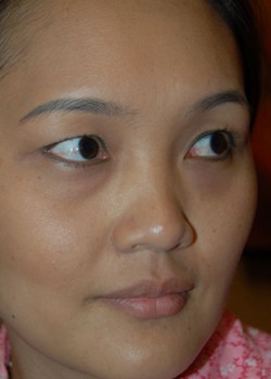 Before Image: Asian Double Eyelid & Lower Eyelid - right-front-oblique