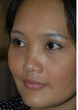 After Image: Asian Double Eyelid & Lower Eyelid - left-front-oblique