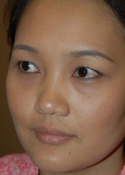 Before Image: Asian Double Eyelid & Lower Eyelid - left-front-oblique
