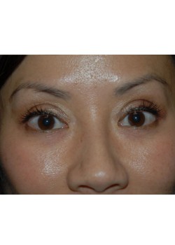 After Image: Asian Double Eyelid - front