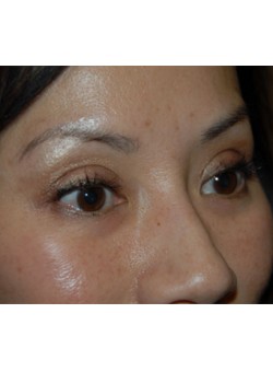 After Image: Asian Double Eyelid - right-front-oblique