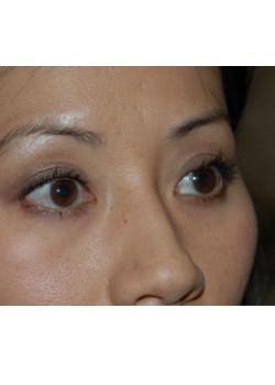 Before Image: Asian Double Eyelid - right-front-oblique