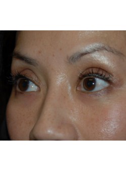 After Image: Asian Double Eyelid - left-front-oblique