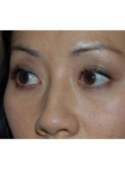 Before Image: Asian Double Eyelid - left-front-oblique