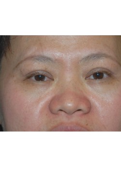 After Image: Asian Double Eyelid - front