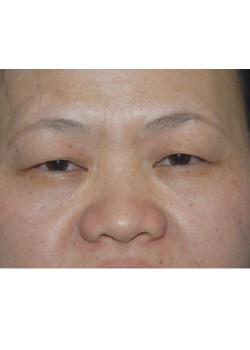 Before Image: Asian Double Eyelid - front