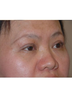 After Image: Asian Double Eyelid - right-front-oblique