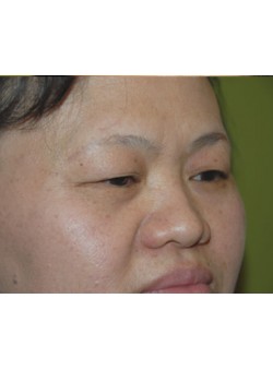 Before Image: Asian Double Eyelid - right-front-oblique