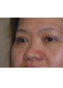After Image: Asian Double Eyelid - left-front-oblique