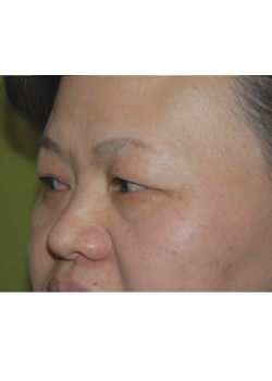 Before Image: Asian Double Eyelid - left-front-oblique