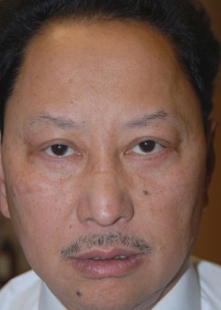 After Image: Asian Double Eyelid and Lower Eyelid - front