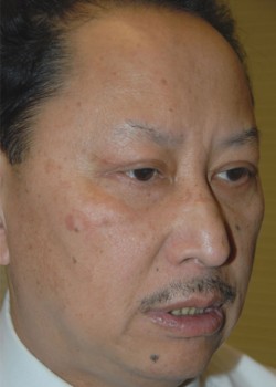 After Image: Asian Double Eyelid and Lower Eyelid - right-front-oblique