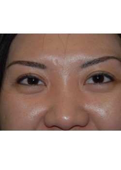 After Image: Asian Double Eyelid - front