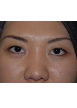 Before Image: Asian Double Eyelid - front
