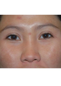 After Image: Asian Double Eyelid - front