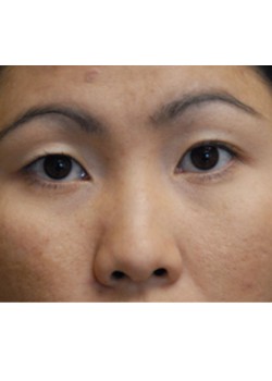 Before Image: Asian Double Eyelid - front