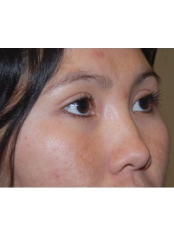 After Image: Asian Double Eyelid - right-front-oblique