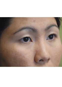 Before Image: Asian Double Eyelid - right-front-oblique