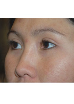After Image: Asian Double Eyelid - left-front-oblique