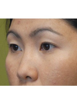 Before Image: Asian Double Eyelid - left-front-oblique