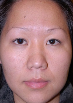 After Image: Asian Double Eyelid - front