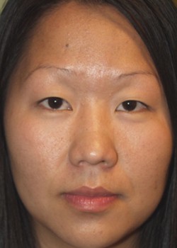 Before Image: Asian Double Eyelid - front
