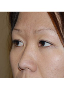 After Image: Asian Double Eyelid - left-front-oblique