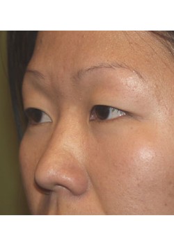 Before Image: Asian Double Eyelid - left-front-oblique