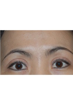 After Image: Asian Double Eyelid - front