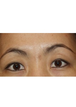 Before Image: Asian Double Eyelid - front