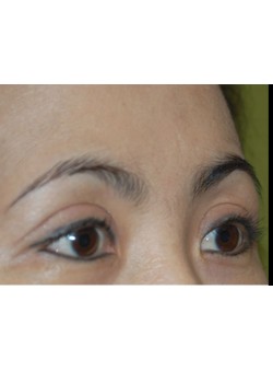 After Image: Asian Double Eyelid - right-front-oblique
