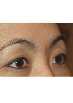 Before Image: Asian Double Eyelid - right-front-oblique