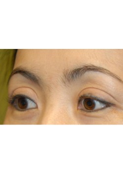 After Image: Asian Double Eyelid - left-front-oblique