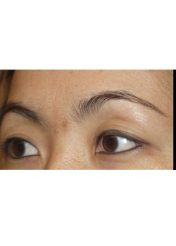 Before Image: Asian Double Eyelid - left-front-oblique