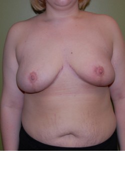 After Image: Breast Reduction - front