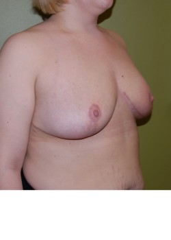 After Image: Breast Reduction - right-front-oblique