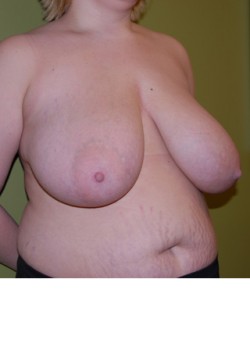 Before Image: Breast Reduction - right-front-oblique