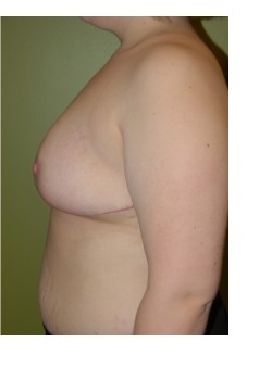 After Image: Breast Reduction - other