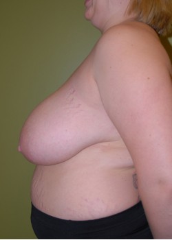 Before Image: Breast Reduction - other