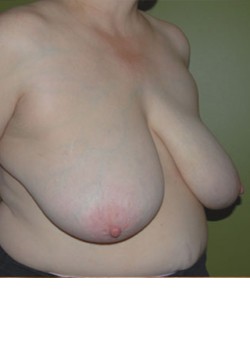 Before Image: Breast Reduction - right-front-oblique